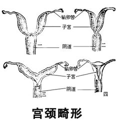 什么是宫颈管发育不良? 