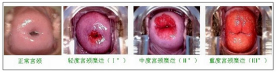 宫颈糜烂的症状表现