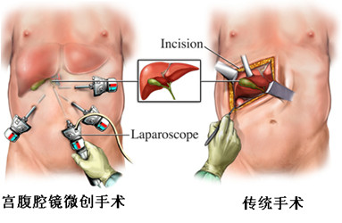 宫腹腔镜微创手术解剖图