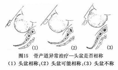 在线咨询：避免难产的原因是什么?