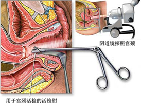 患了宫颈息肉怎么办_宫颈息肉的检查方法