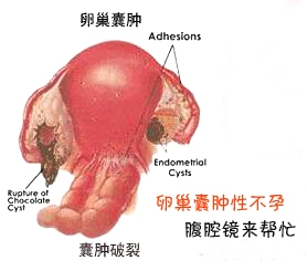 如何治疗卵巢囊肿引起的不孕