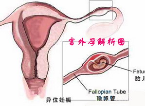 妇产专家简述：宫外孕复发的原因