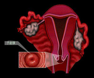 如何从症状早发现“宫颈炎”