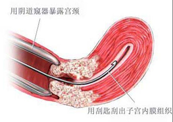 宫颈癌可防可治  不可怕