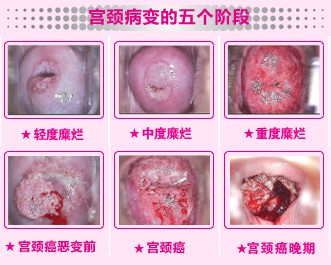 如何治疗宫颈糜烂?和田哪家医院治疗宫颈糜烂比较好?