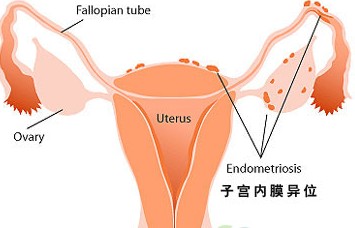 夏季防晒乳可能导致子宫内膜异位症