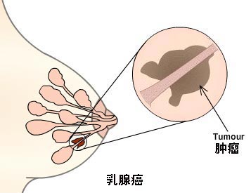  女性曲线杀手——乳腺癌