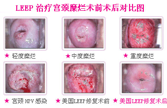 宫颈癌前病变的症状