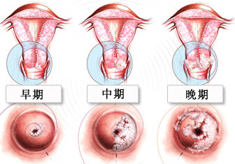 宫颈糜烂到底是不是宫颈炎
