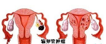 患了输卵管肿瘤会影响生育吗