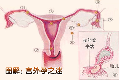 患上宫外孕异常症状有哪些?