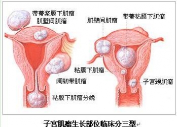 子宫肌瘤就失去了生育能力?