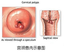 不要把宫颈息肉误当宫颈炎 