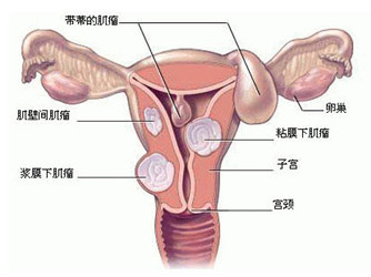 陇南哪家医院治疗子宫肌瘤好?